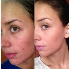 Acne breakout after steroids