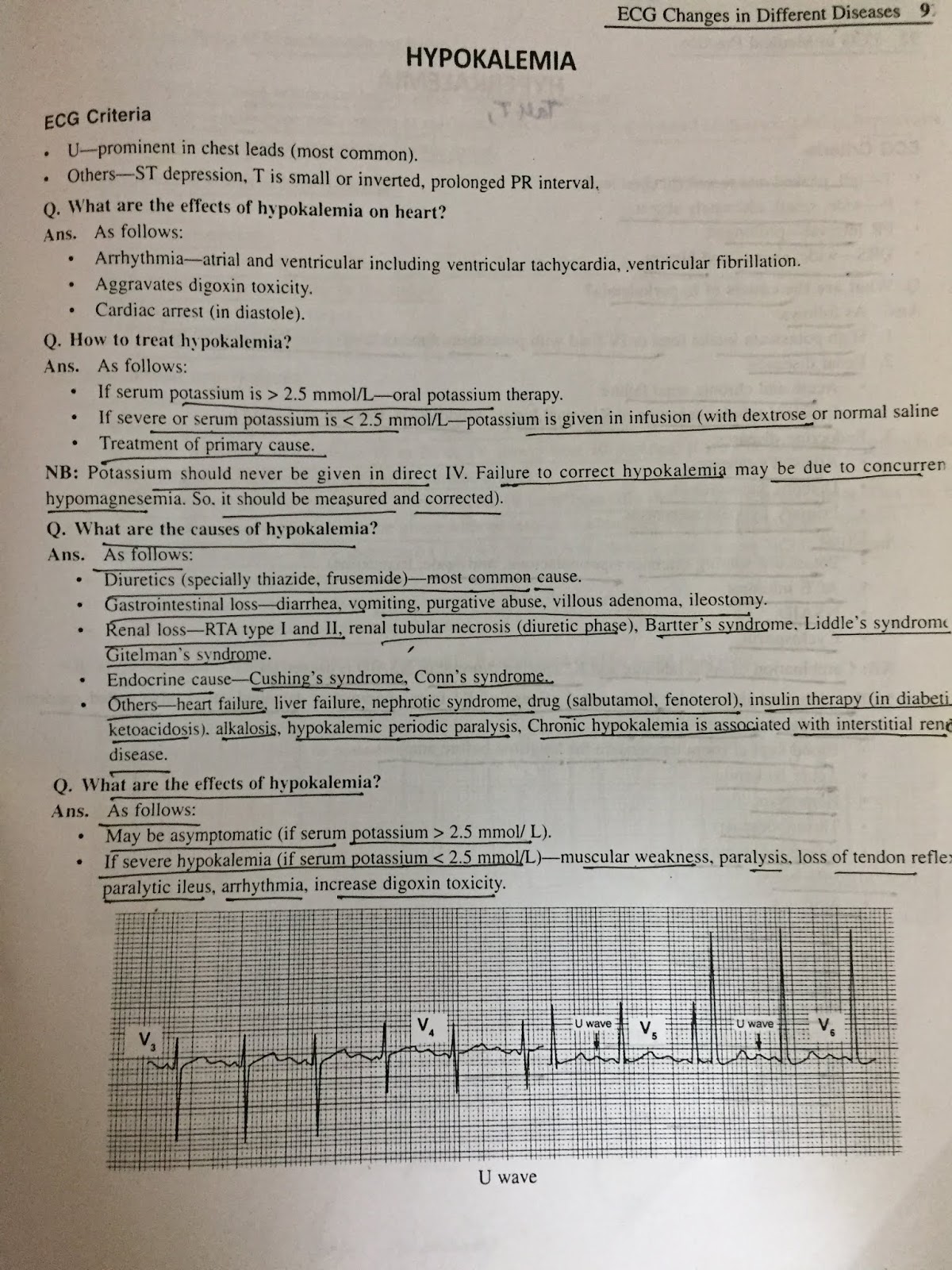 ECG DIGITALIS EFFECT ,HYPOKALEMIA AND HYPERKALEMIA
