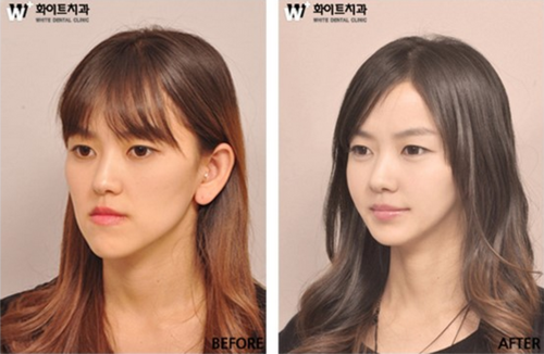 Wajah Asli Wanita Korea Sebelum dan Setelah Operasi Plastik