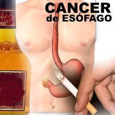 cáncer de esófago