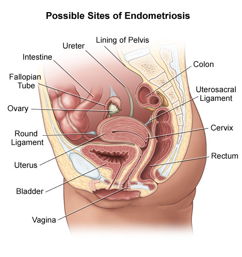 HEiDiMatEs MeDICinE Endometriosis heidimates-medicine-endometriosis