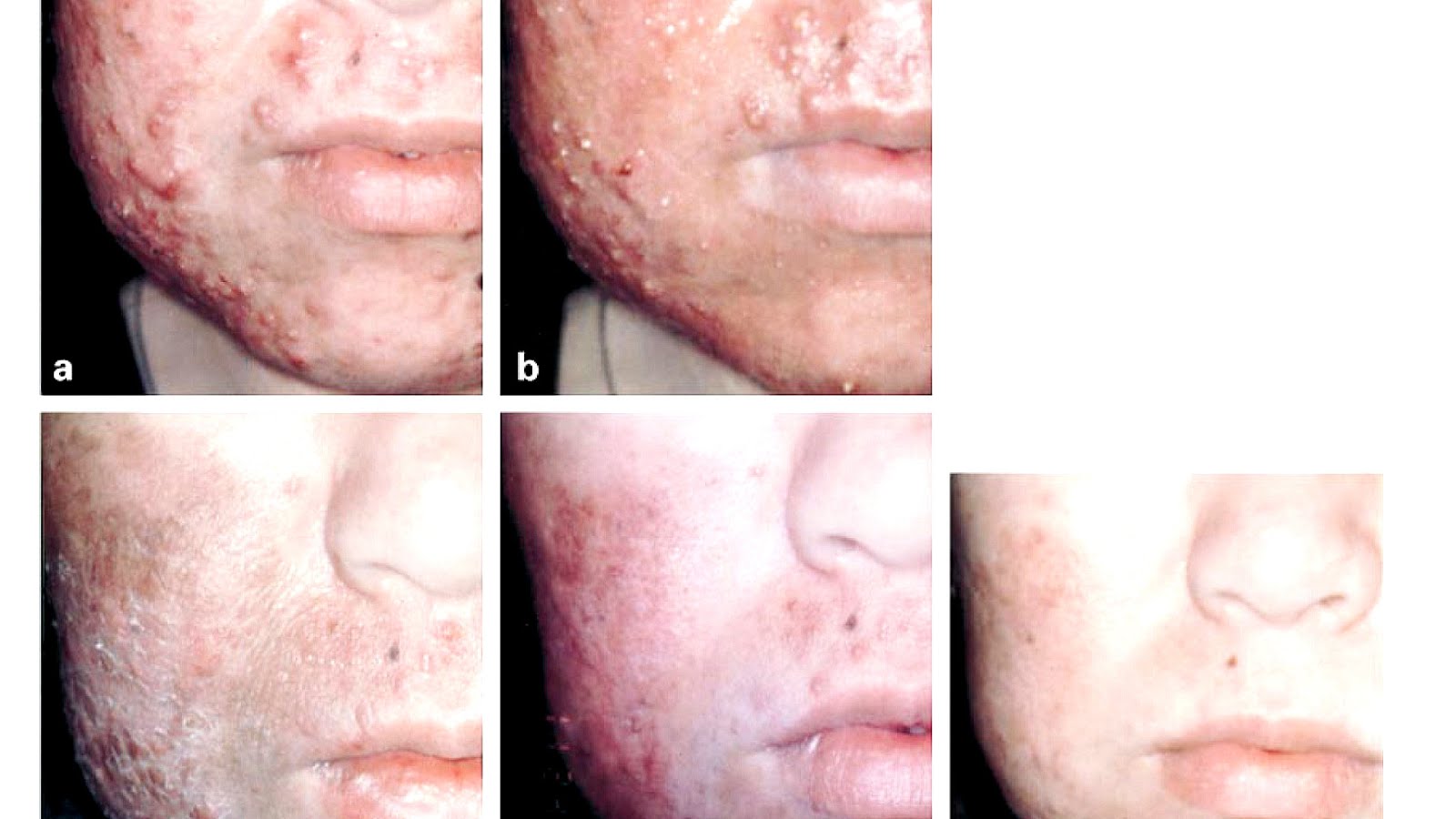 Photodynamic Therapy Photos Before And After  Photo Choices