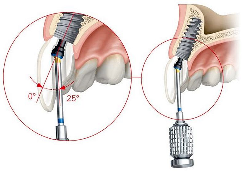 ANGULATED SCREW CHANNELS Design and angulation of a screw retained dental implant crown
