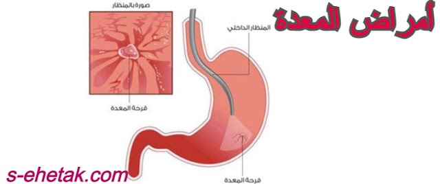 أمراض المعدة