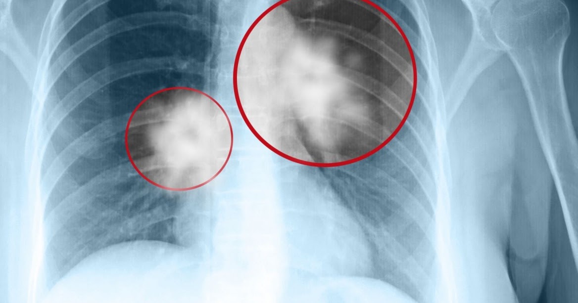 Cancer Immunology Cancer is the enemy, not the patient