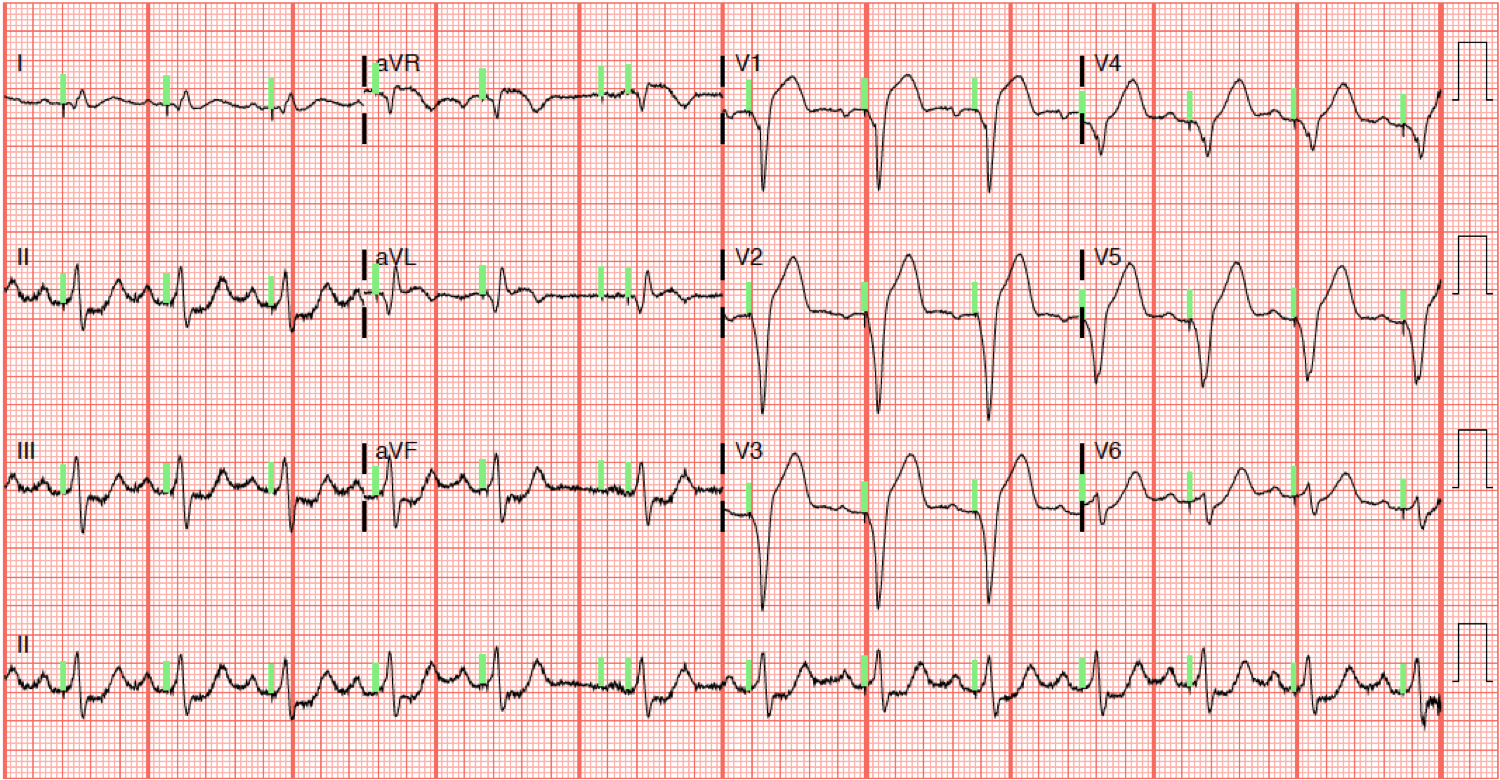 Dr. Smith's ECG Blog A patient with a ventricular paced rhythm and