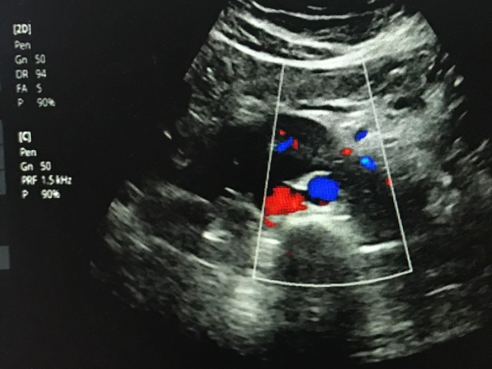 VIETNAMESE MEDIC ULTRASOUND CASE 560 TUMOR IN HORSESHOE KIDNEY, Dr