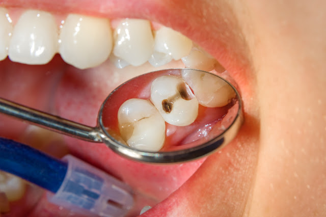 10 Cara Alami Mengobati Sakit Gigi Berlubang