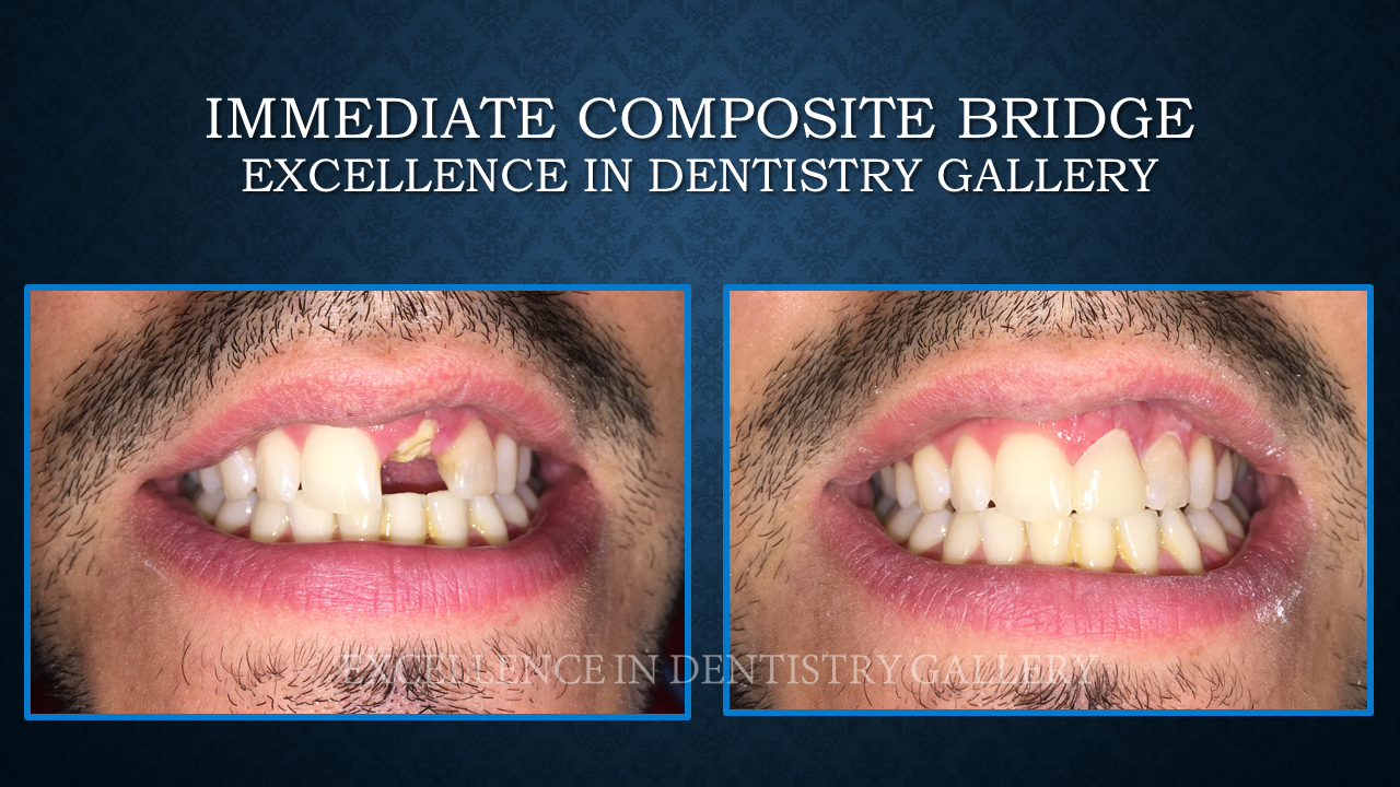 Lepas pakai retainer, composite bridge pula