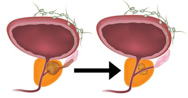 Utilisation de la plante Neem pour le traitement du cancer de la prostate