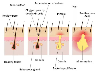 how acne form in skin