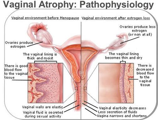 Womens Health Genitourinary Syndrome Of Menopause-8079