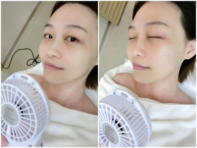 LMSKINCENTRE, 脫疣, CO2Laser, Thermage, 二氧化碳激光, 油脂粒, lovecathcath, catherine, 夏沫, lovecath, beauty, skincare