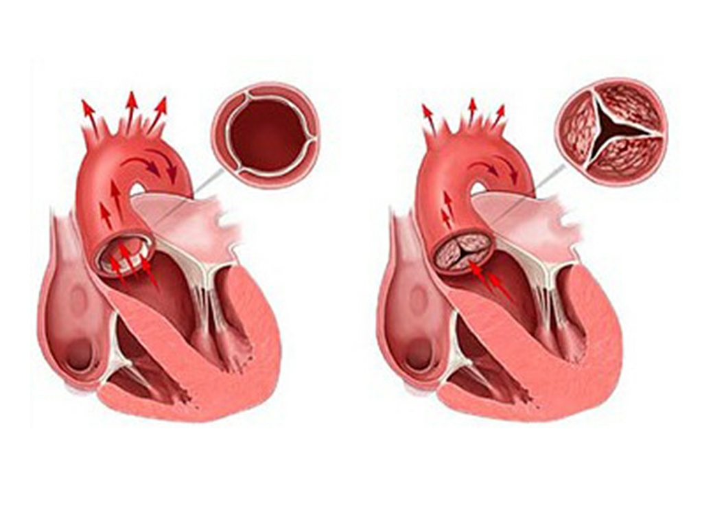 Митральный аортальный стеноз. Аортальный стеноз (сужение отверстия аорты);. Стеноз аортального клапана у новорожденных. Суправульвулярный аортальный стеноз. Аортальный стеноз кальциноз.
