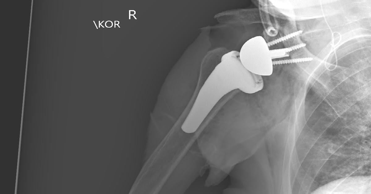 Shoulder and Elbow Surgery Short stems in reverse total shoulder