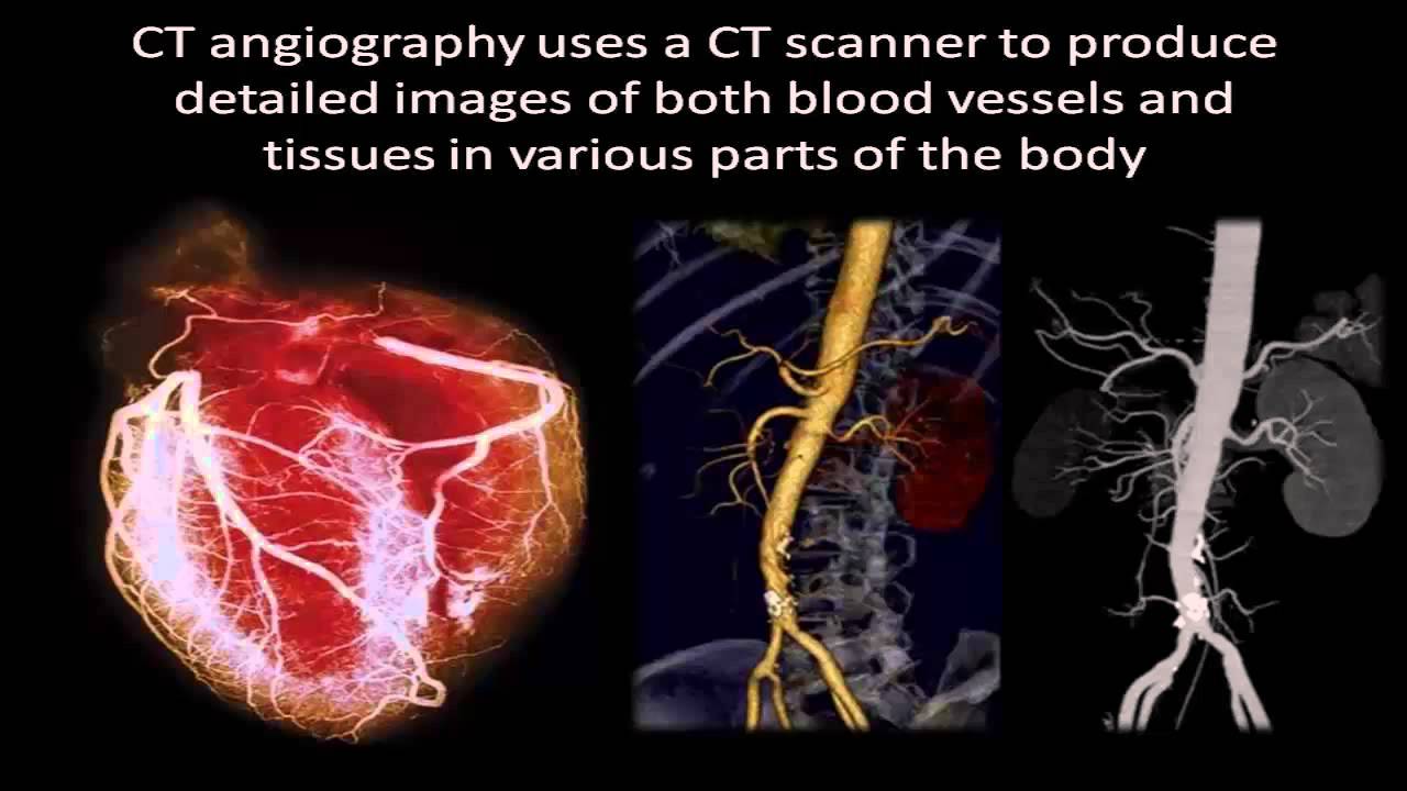 O QUE É ANGIOTOMOGRAFIA? LAMOREABIO BIOLOGIA HUMANA E SAÚDE O QUE É ANGIOTOMOGRAFIA? LAMOREABIO BIOLOGIA HUMANA E SAÚDE