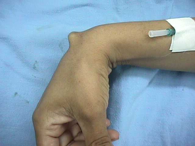 OSSA CARPALIA ©: GANGLION DE LA MUÑECA.