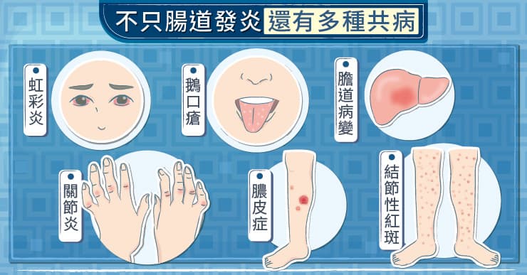 不只腸道發炎，還有多種共病