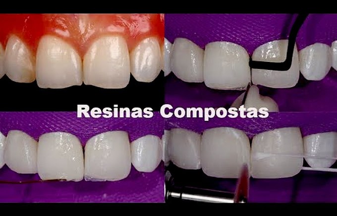 RESINAS COMPOSTAS: A Solução Mais Natural e Conservadora para Dentes Desgastados - Curso Leonardo Muniz