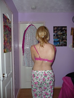 scoliosis photo before scoliosis surgery