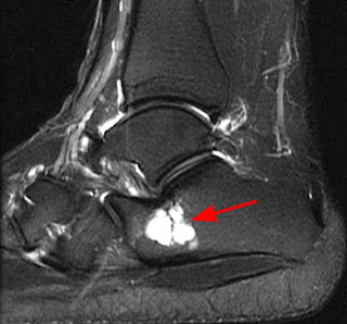 MRI Musculo-Skeletal Section: Lateral hindfoot impingement.