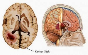 obat alami kanker otak stadium 1, obat alami tumor otak, Obat Kanker Otak