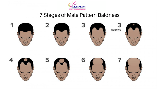 Stages of male pattern baldness