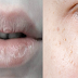 5 Major Signs Of Chronic Vitamin Deficiency In Women That Show Up In Your Body