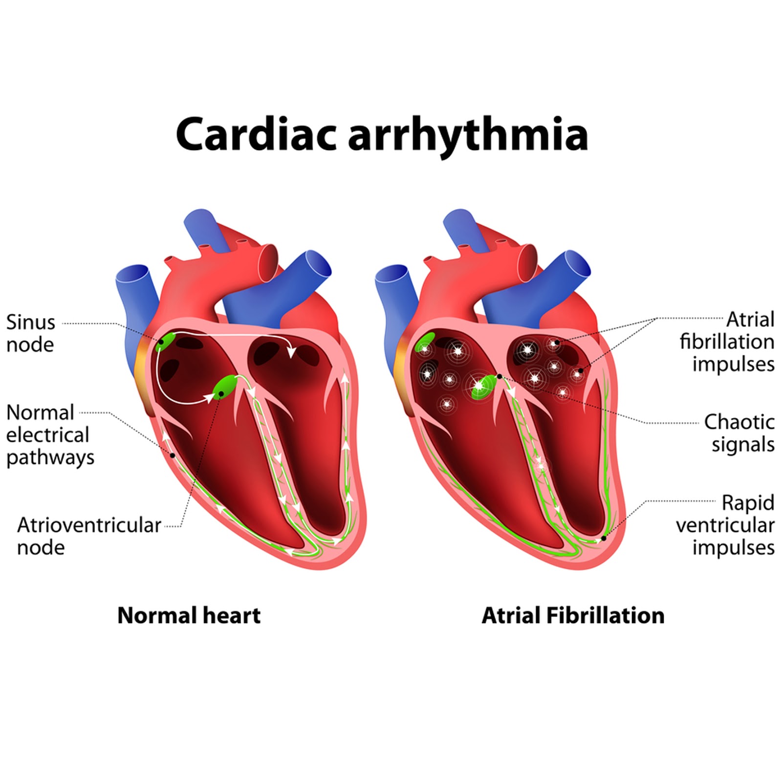 экстрасистолия схема экг. сердцебиение неприятное. перебои в работе сердца. аритмия и экстрасистолия на экг. аритмический инфаркт миокарда клиника.