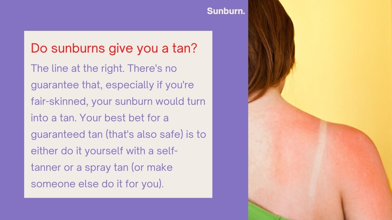 sunburn-Symptoms-Signs-causes-treatments