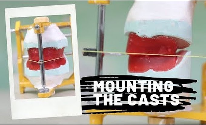 PROSTHODONTICS: Mounting the casts on a mean value articulator