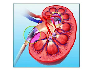 What is Renal stones