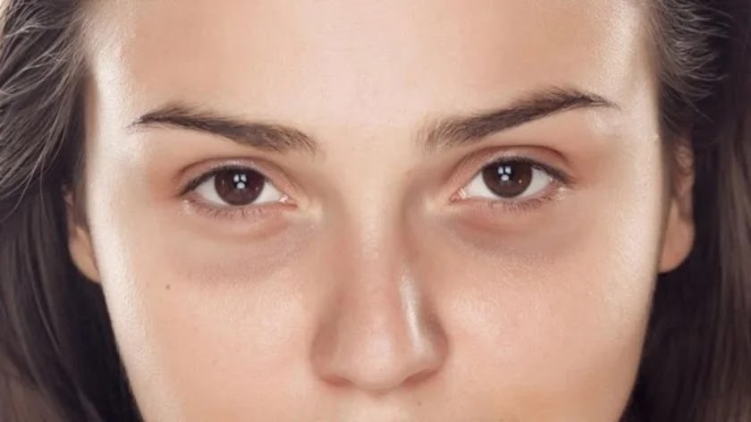 بالفيديو: الهالات السوداء.. أحدث "صيحة جمالية"