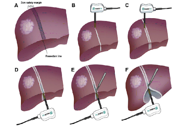 Laparoscopic Treatment Purpose Procedure And Recovery Liver Resection