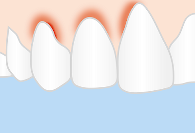 Nguyên nhân gây viêm nướu răng ở trẻ