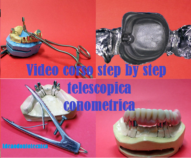  video corso step by step protesi telescopica conometrica