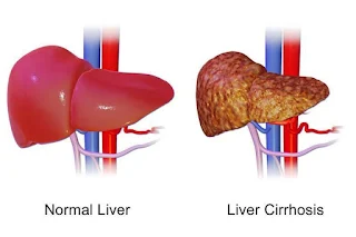 Liver normal dengan yang menderita Sirosis Hati