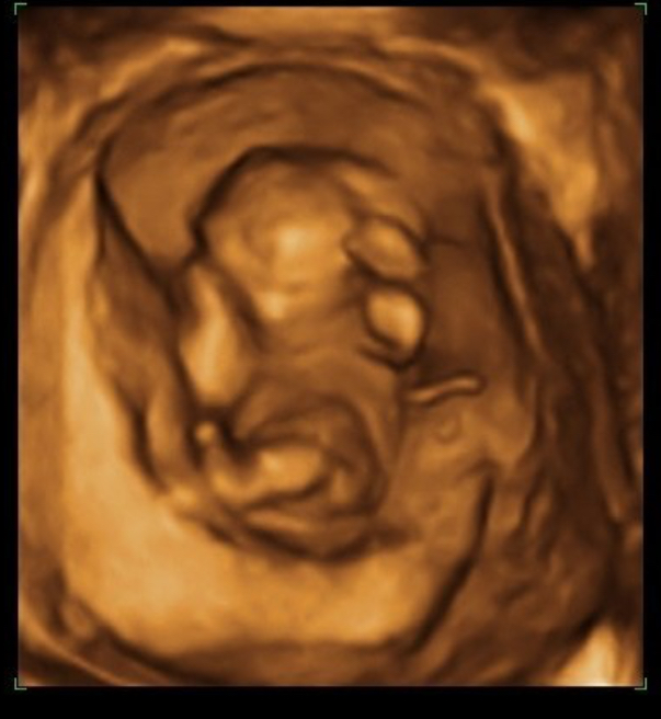 12 Haftalık Gebelik