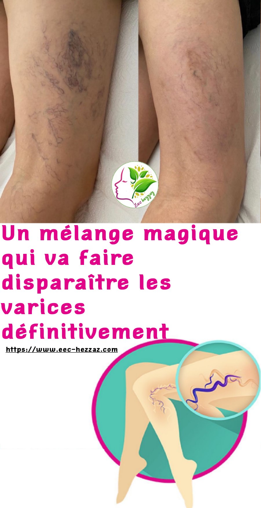 Un mélange magique qui va faire disparaître les varices définitivement