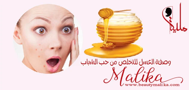 وصفة العسل الطبيعي الخام للتخلص من حب الشباب وصفة العسل الطبيعي الخام للتخلص من حب الشباب