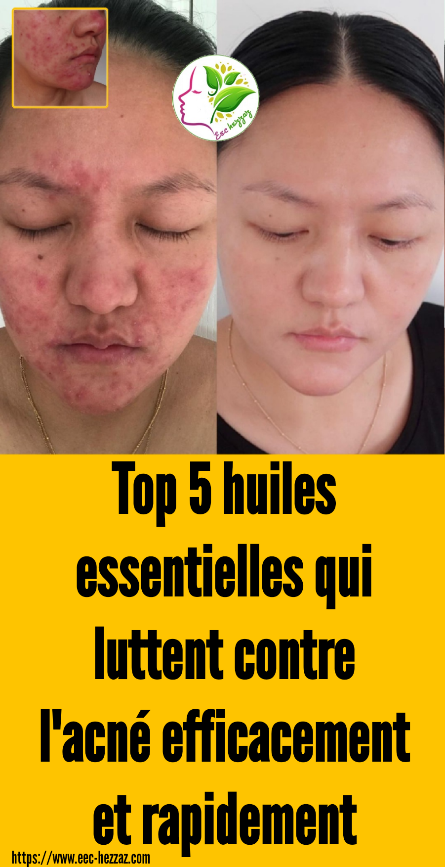 Top 5 huiles essentielles qui luttent contre l'acné efficacement et rapidement