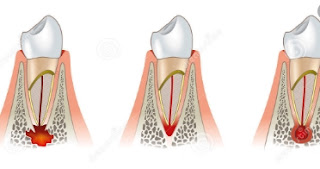 Periodonsia Periodonsia