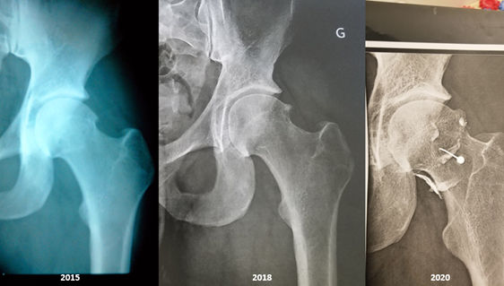 Le conflit de hanche: une blessure de triathlète – Docdusport