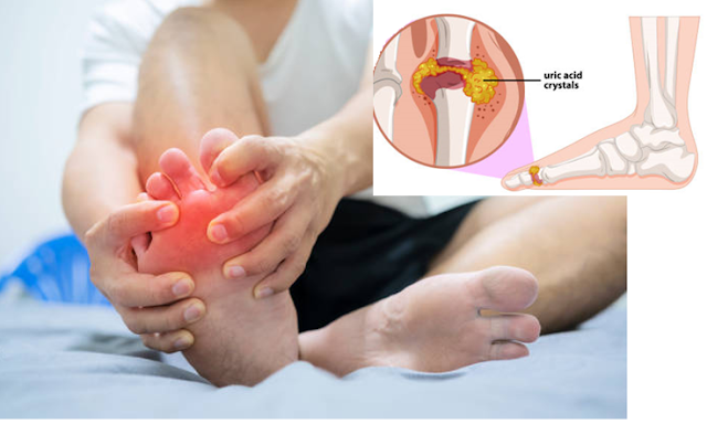 9 questions patients often care about when suffering from gout How long does a gout attack last and how often does it occur