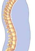 Kelainan Tulang Belakang - kifosis