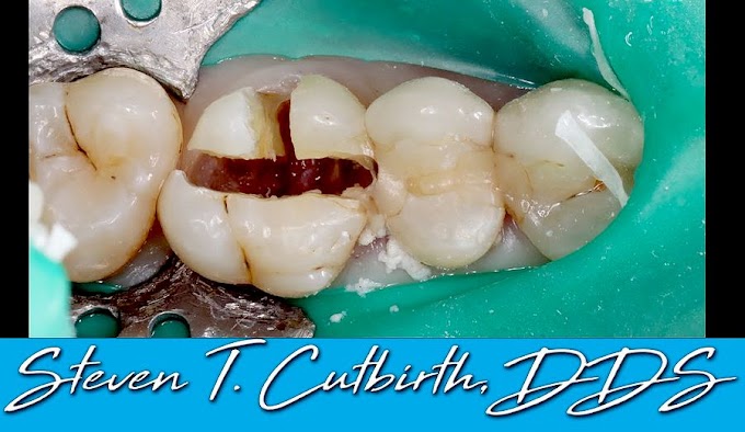 EXODONTICS: Sectioning and Extraction of Maxilary first Molar - Steven T. Cutbirth, DDS