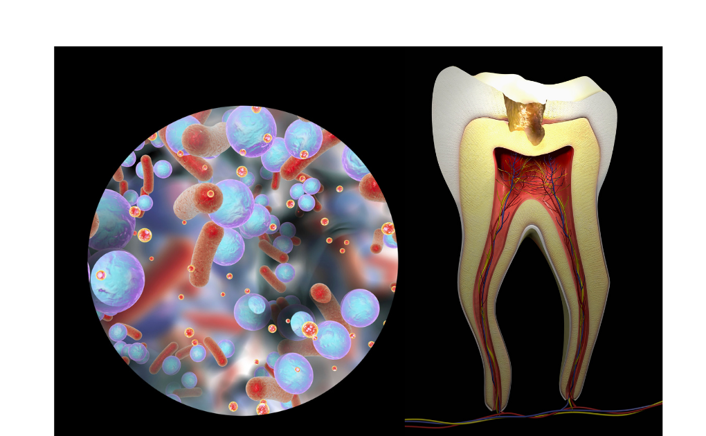 It's Contagious! How to Control Tooth Decay and Keep It From Spreading
