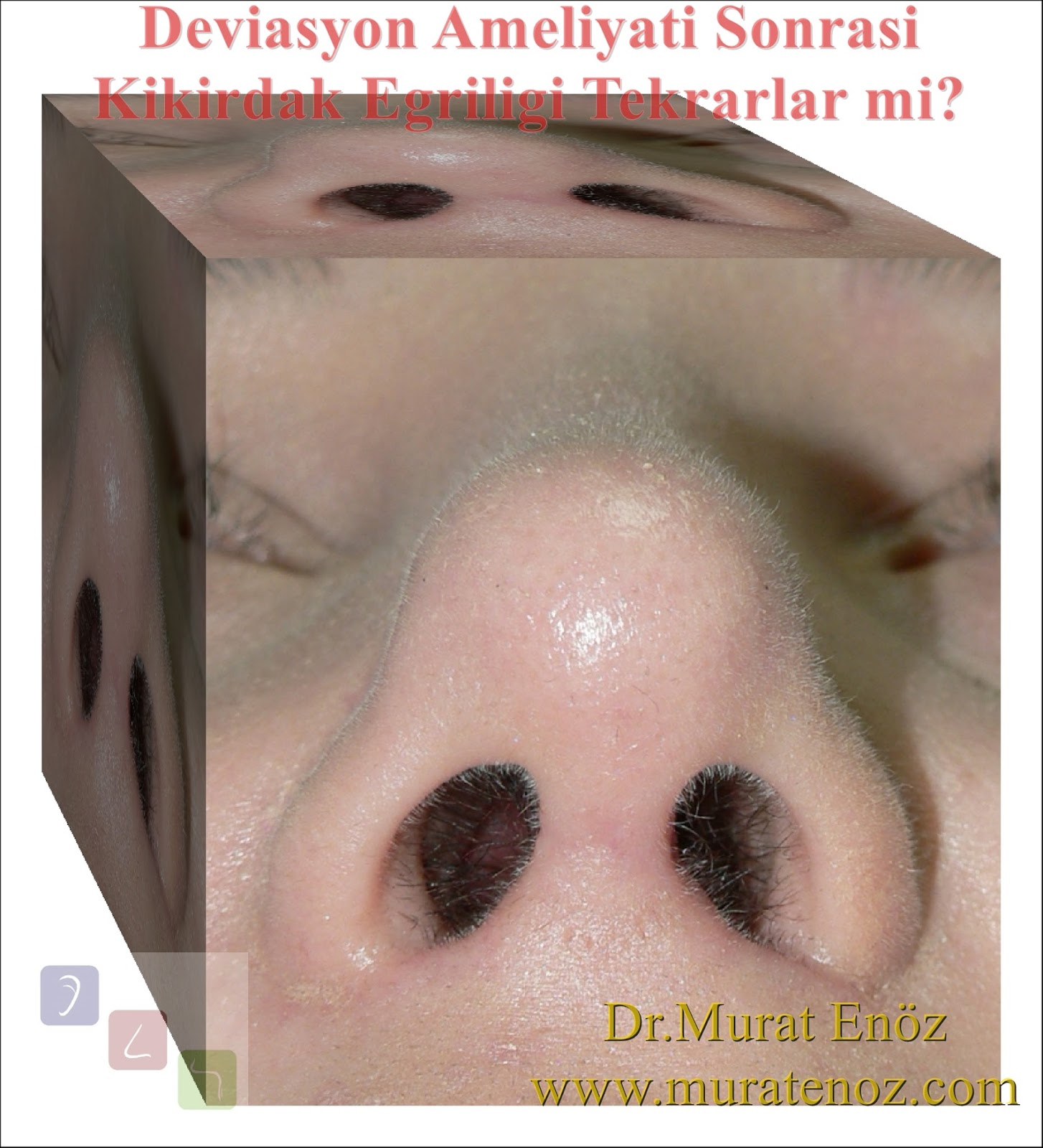 Deviasyon Ameliyati Sonrasi Kikirdak Egriligi Tekrarlar Mi