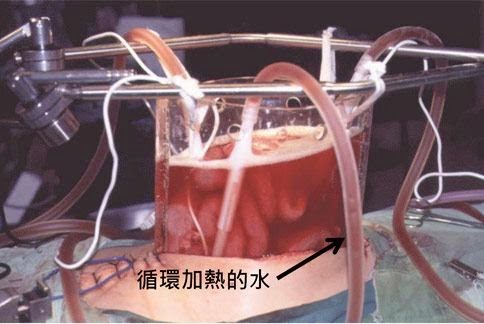 腹腔溫熱化學療法　提升肝腫瘤破裂者存活率