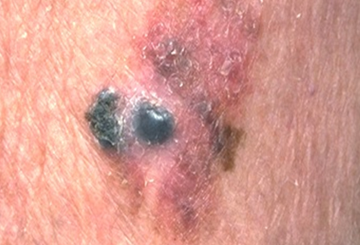 Slide show: Melanoma pictures to help identify skin cancer ...